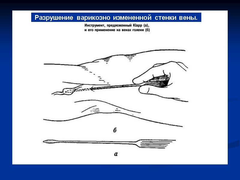 Разрушение варикозно измененной стенки вены.
